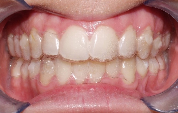teeth straightener clear