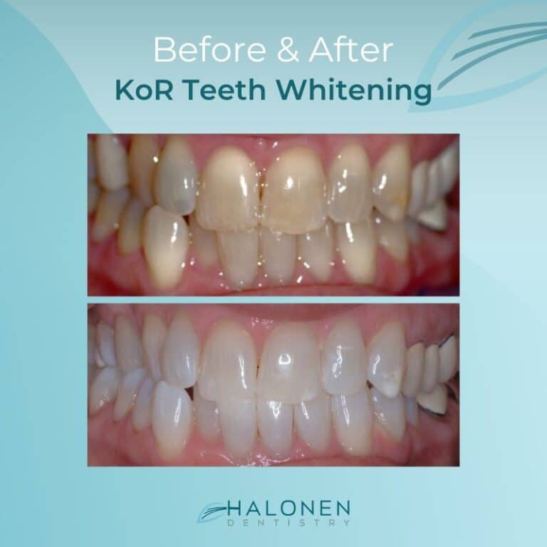 before after teeth whitening