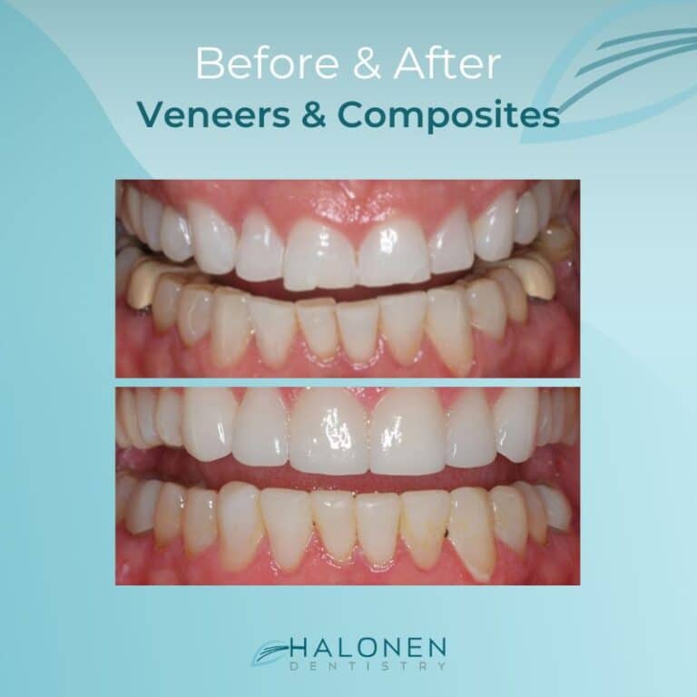 Veneers and Composites before and after