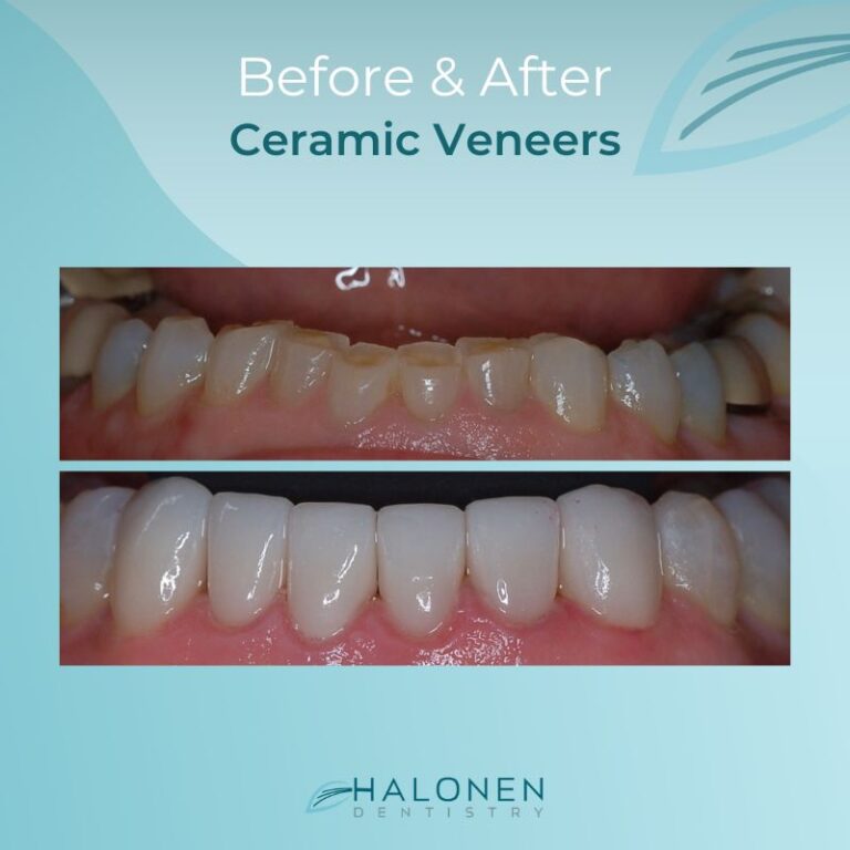 before and after veneers