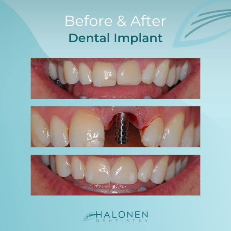 dental implant before and after